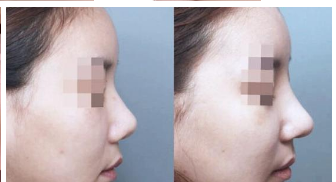 假体隆鼻
