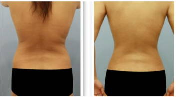 南京腰部抽脂对身体会有副作用吗?