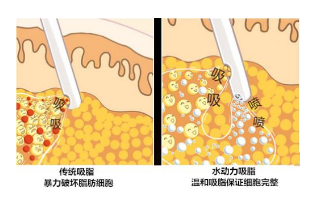南京腰部抽脂对身体会有副作用吗?