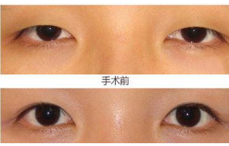 拯救“眯眯眼”只需要做个上睑下垂矫正!