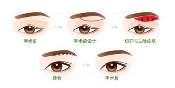 眼部的眼睑下垂和眼睑浮肿是一回事吗?