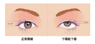 南京眼睑下垂矫正开启“美眼时代”!