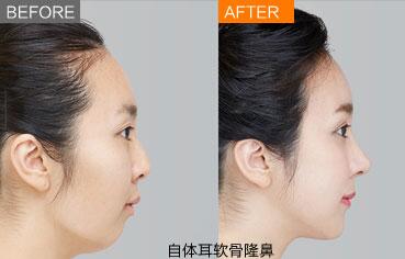 南京假体隆鼻后要更换假体吗?