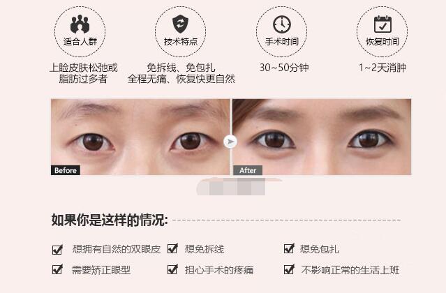 南京水泡眼可以做双眼皮吗?
