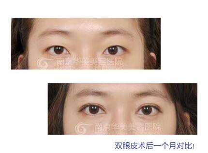 做埋线双眼皮手术需要注意的事项?