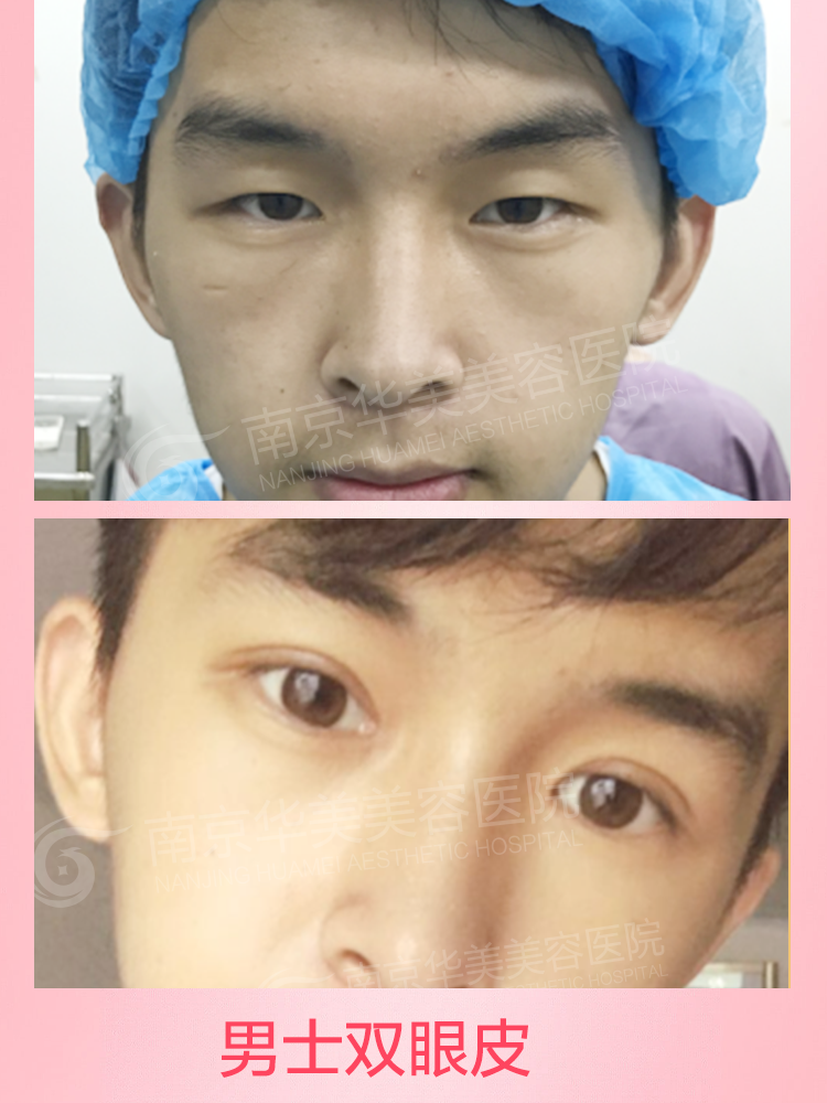 双眼皮