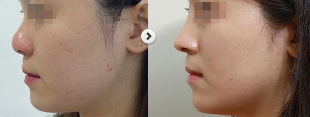 做隆鼻选择哪家医院比较好呢