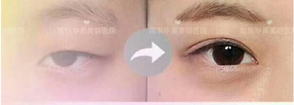双眼皮