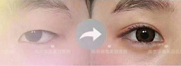 做埋线双眼皮恢复时间快吗?