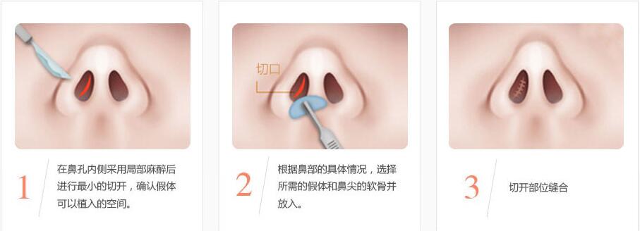 南京做假体隆鼻的材料可以使用多久?