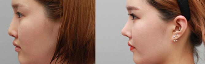 南京做注射隆鼻会有缺陷吗?