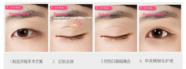 单眼皮变双眼皮的方法?