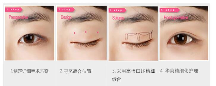 南京做埋线双眼皮后会被看出来吗?