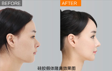 隆鼻手术效果安全吗