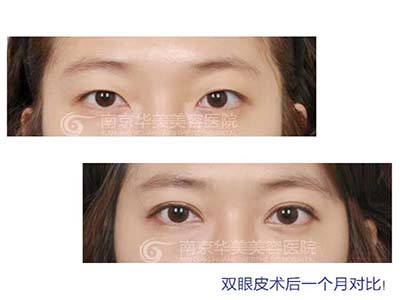 南京双眼皮手术去哪家医院做好